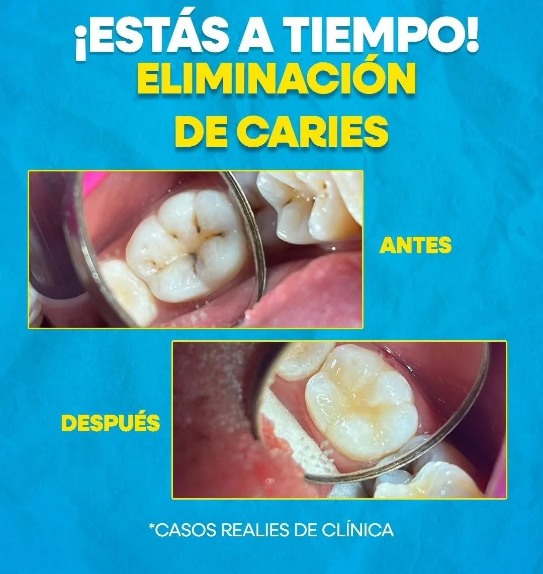 Antes y después caries